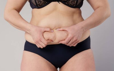 Abdominoplastia con liposucción