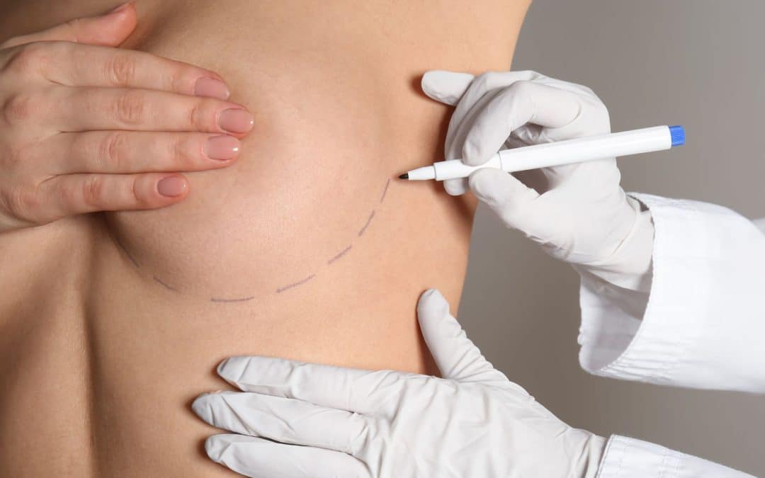 Técnica dual plane: un avance significativo en la cirugía de aumento mamario