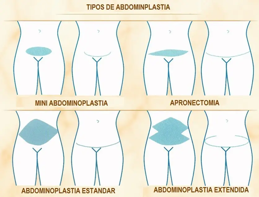 tipos de abdominoplastia